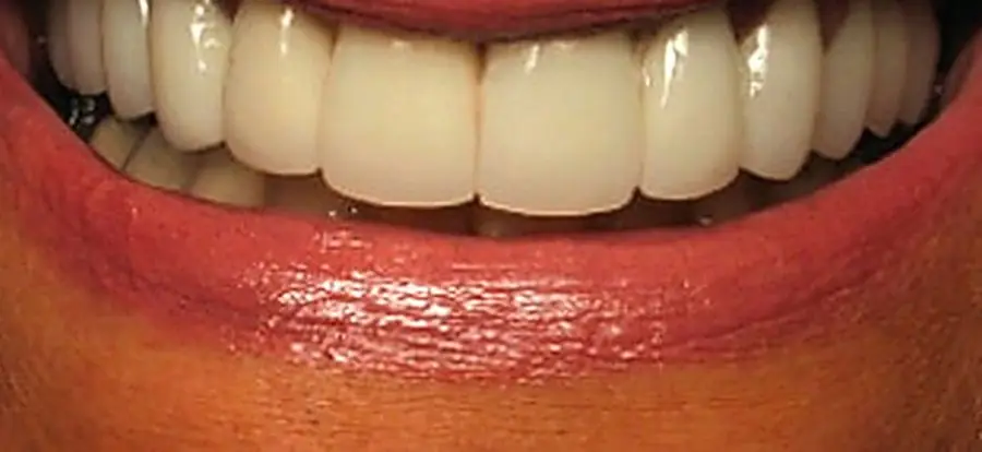 The same patient after treatment by Dr. Kurpis.