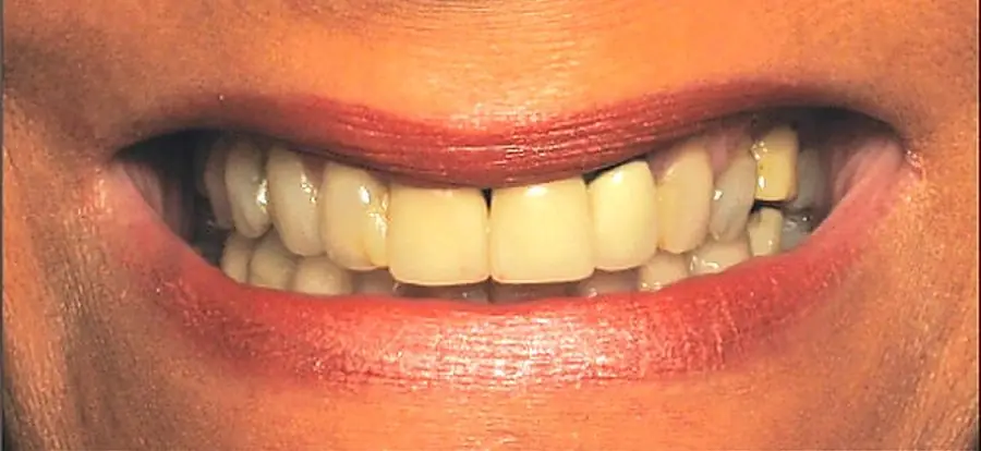 Patient smile before treatment.