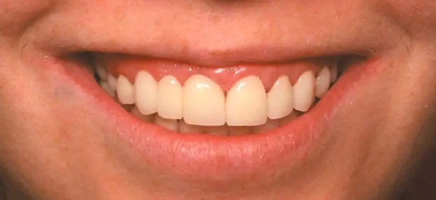 A finished smile.