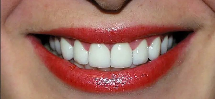 Porcelain restoration, finished.