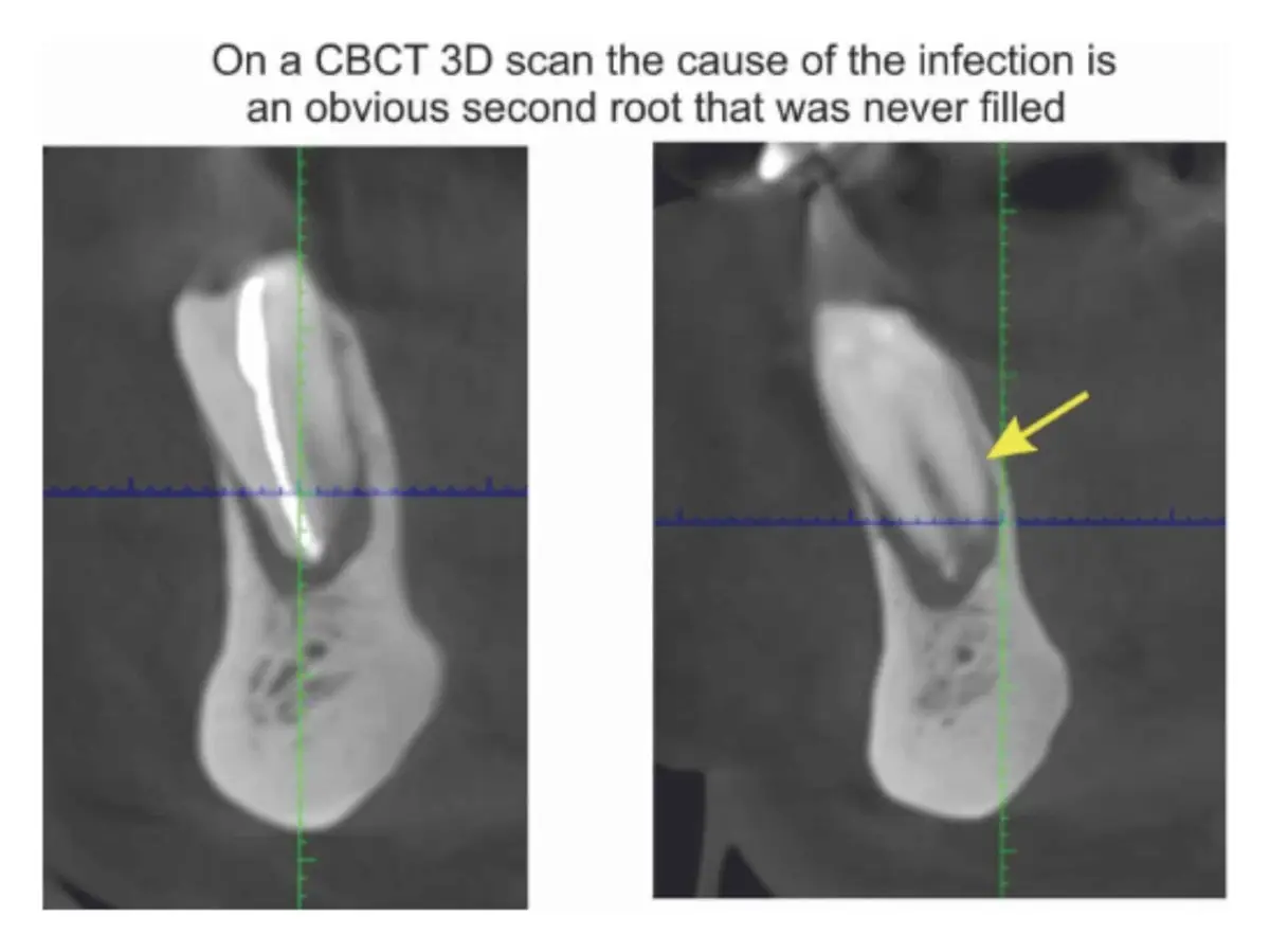 A CBCT 3D scan showing an unfilled second root canal a flat X-ray had missed.