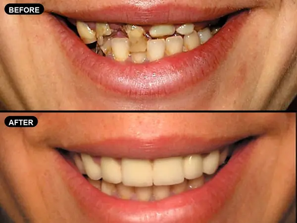 A mouth other dentists called hopeless, before and after full mouth reconstruction.