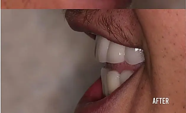 Adult profile after non-surgical underbite correction.