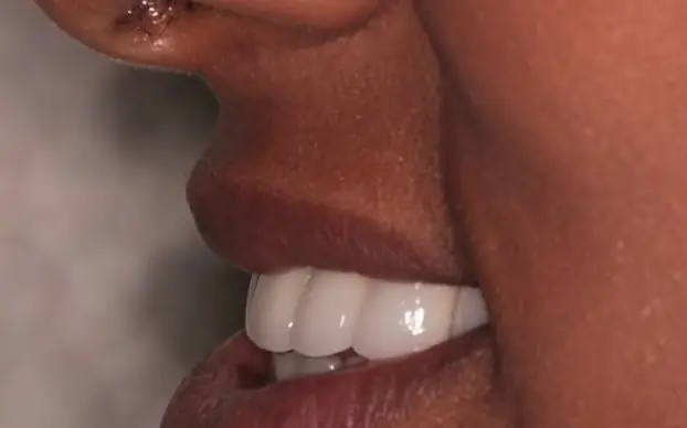 The same patient after non-surgical underbite correction, the bite rebuilt rather than the jaw moved.